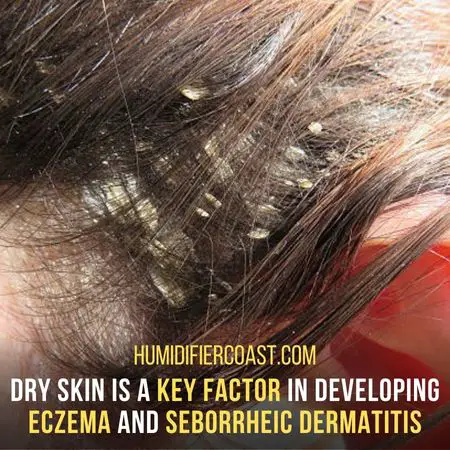 Reduce Eczema And Seborrheic Dermatitis Symptoms