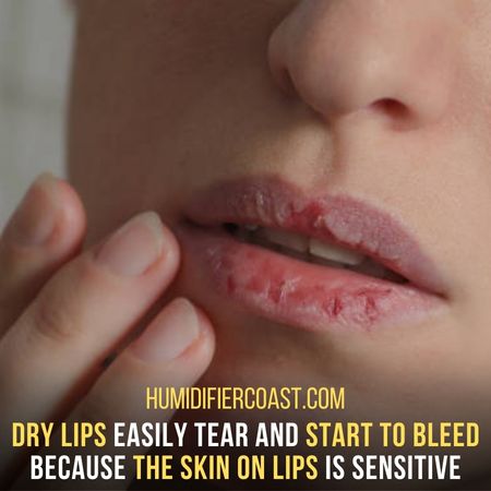 Dry Lip's Skin - Can A Humidifier Help With Dry Skin?